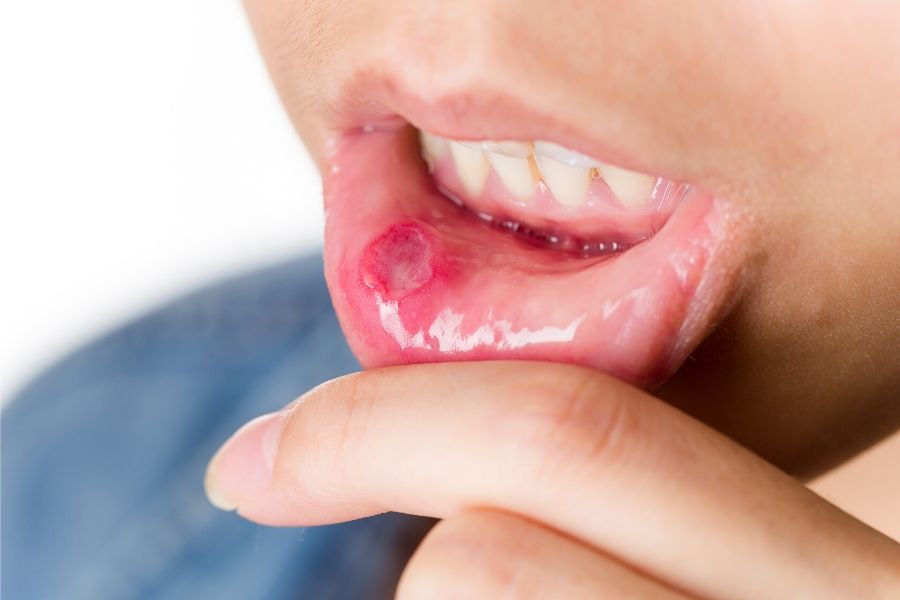Jak skutecznie pozbyć się afty z jamy ustnej?