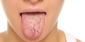 Kserostomia czyli Suchość w jamie ustnej
